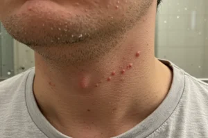 Men’s Razor Burn: Conquering Irritation by 2028